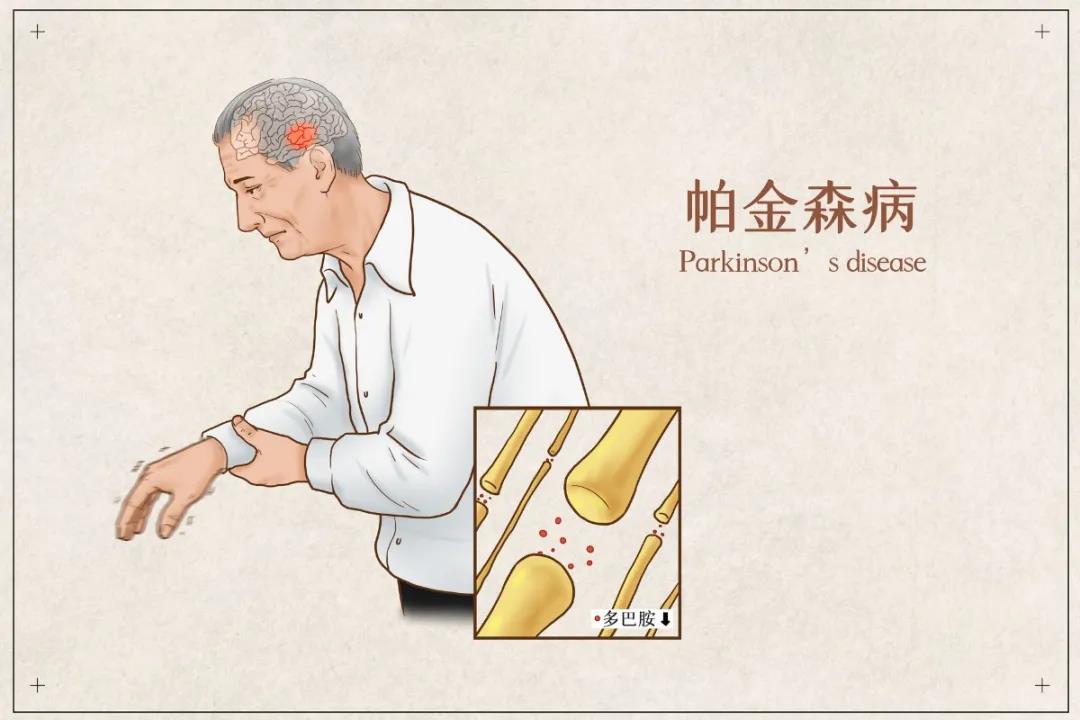 青岛养老院教你如何预防帕金森